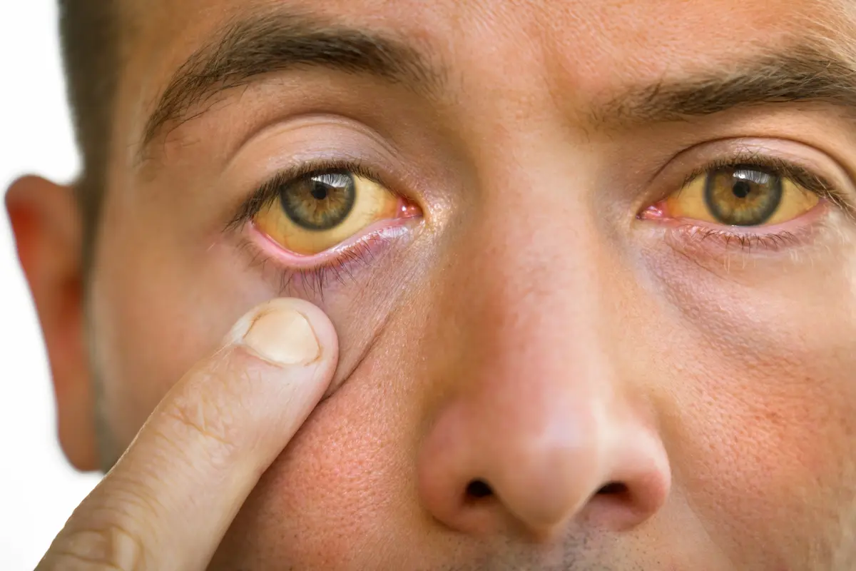 causes-of-scleral-icterus causes of scleral icterus