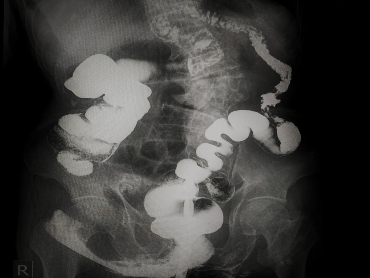 lower-gi-bleed lower GI bleed in Miami